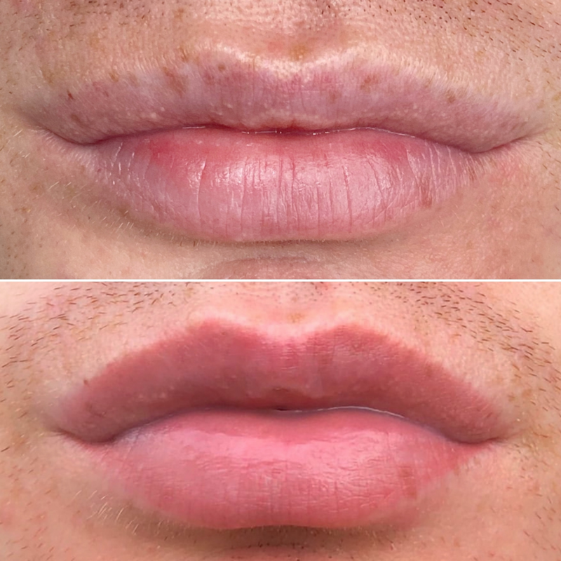 Male Lip Blush Procedure Case Study by Jasmine Diebelius