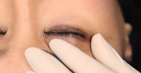 Mini Eyeliner Procedure Outline