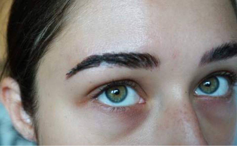 Brianna After Microblading Procedure Healing Day 5-7