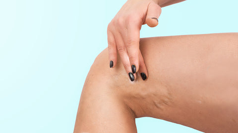 prevent the formation of varicose veins