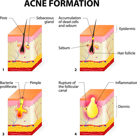 How acne forms on the skin
