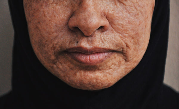 woman with severe acne scars