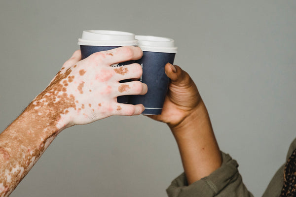 vitiligo vs normal skin