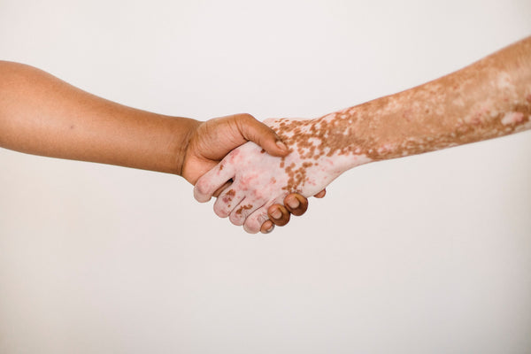 vitiligo vs normal skin shaking hands