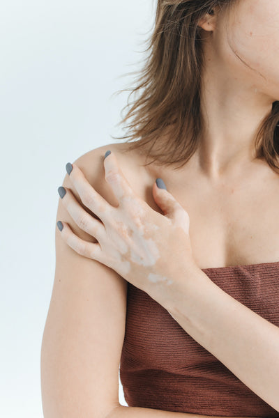 woman with vitiligo patches on fair skin