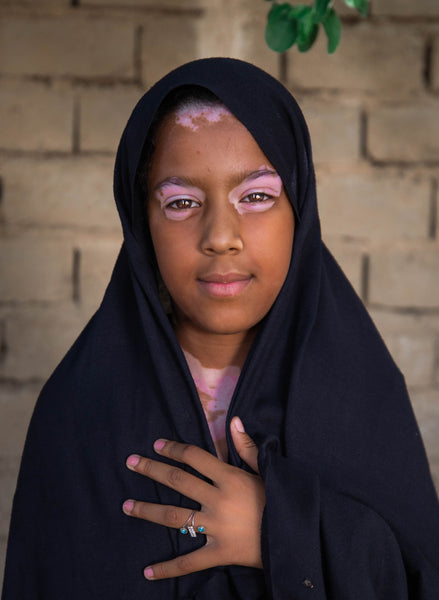 girl with vitiligo on dark skin