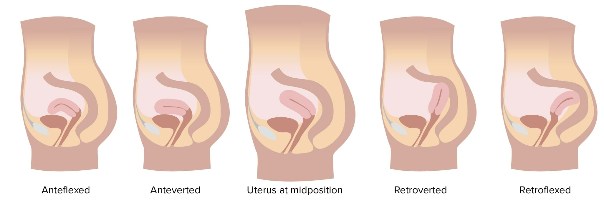 tilted uterus