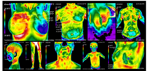 thermography ny