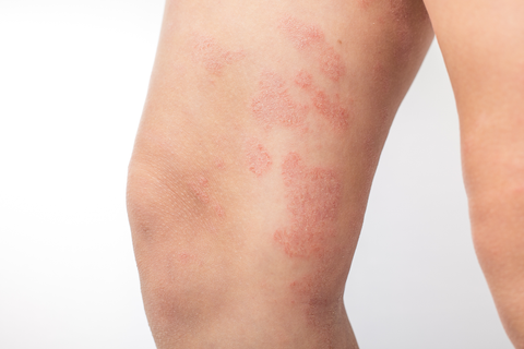 an eczema picture on adult: Picture of a leg with atopic dermatitis (eczema) with symptoms of eczema dry skin