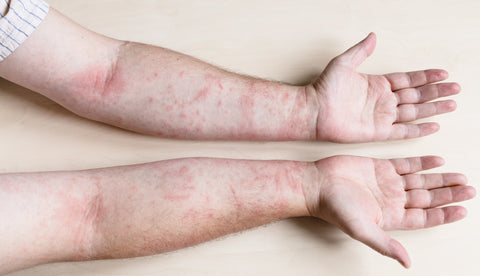 Severe Eczema Flare up on hands and arms. Specific type of eczema Contact Dermatitis pictured, displaying red flaky eczema patches