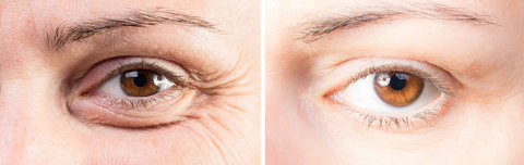 Botox Before and After Photos: Botox results for women who received botox treatment for wrinkles and crows feet