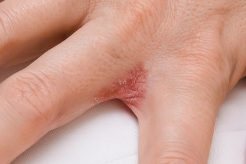 Image of what eczema looks like on hands, with a flare up of what dyshidrotic eczema (a severe skin eczema) that displays red flaky eczema symptoms on hands.