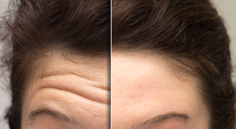 Botox Before and After Photo: Women who received Botox Injectibles for forehead
