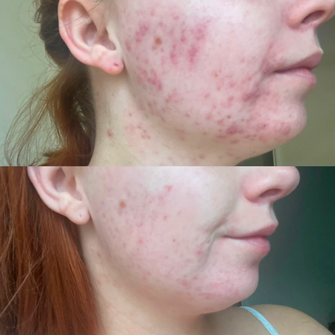 skincare before and after