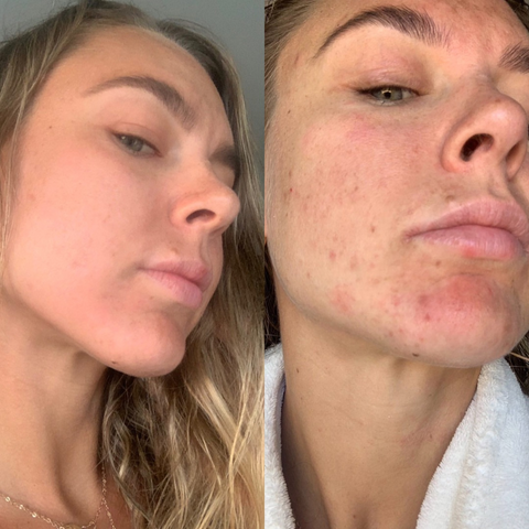 skincare before and after