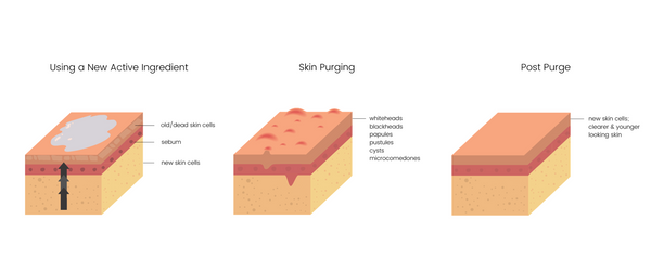 skin purging infographic