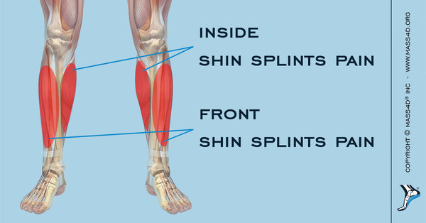 Causes and Symptoms of Shin Splints 
