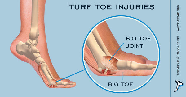 What Are Turf Toe Injuries? | MASS4D 