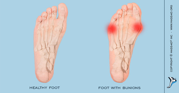 arch support for bunions