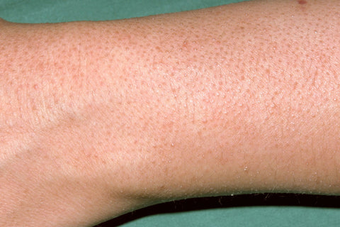 Keratosis Pilaris