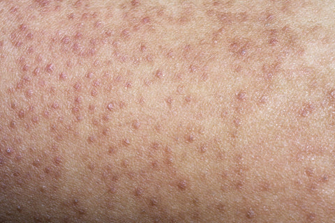 What is Keratosis Pilaris and How To  Manage It