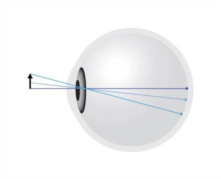 A normal eye where the image is projected on the retina, both centrally and peripherally