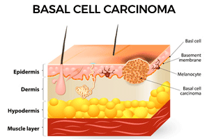 basal cell carcinoma