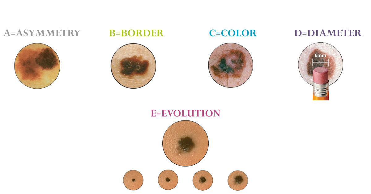 melanoma detection