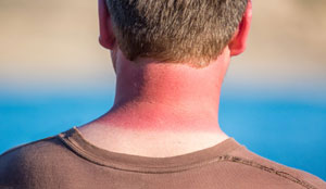 weird sunburn locations back of neck