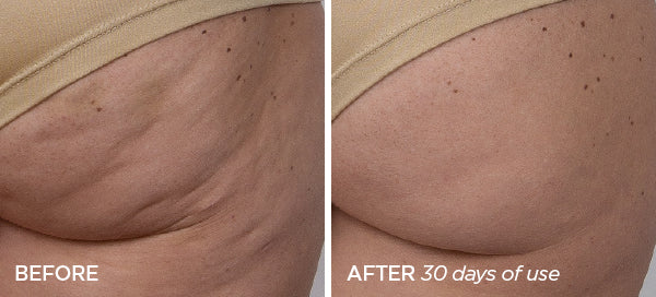 Body Microneedling Dimples