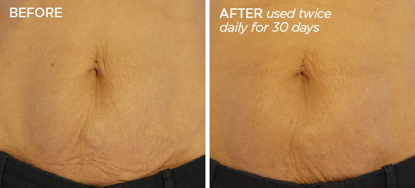 Body Microneedling Stomach