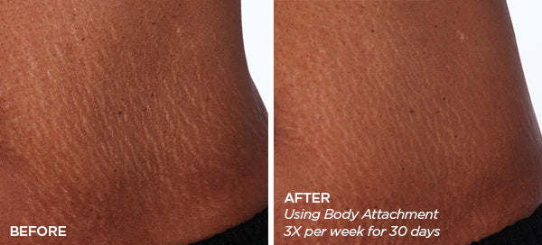 GloPRO Body Images Before and After Derma Rolling for Stretch Marks