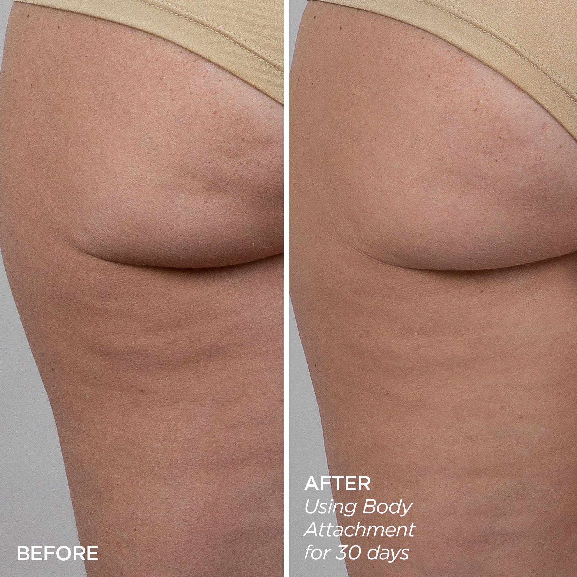 Before & After image using the GloPRO Body MicroTip