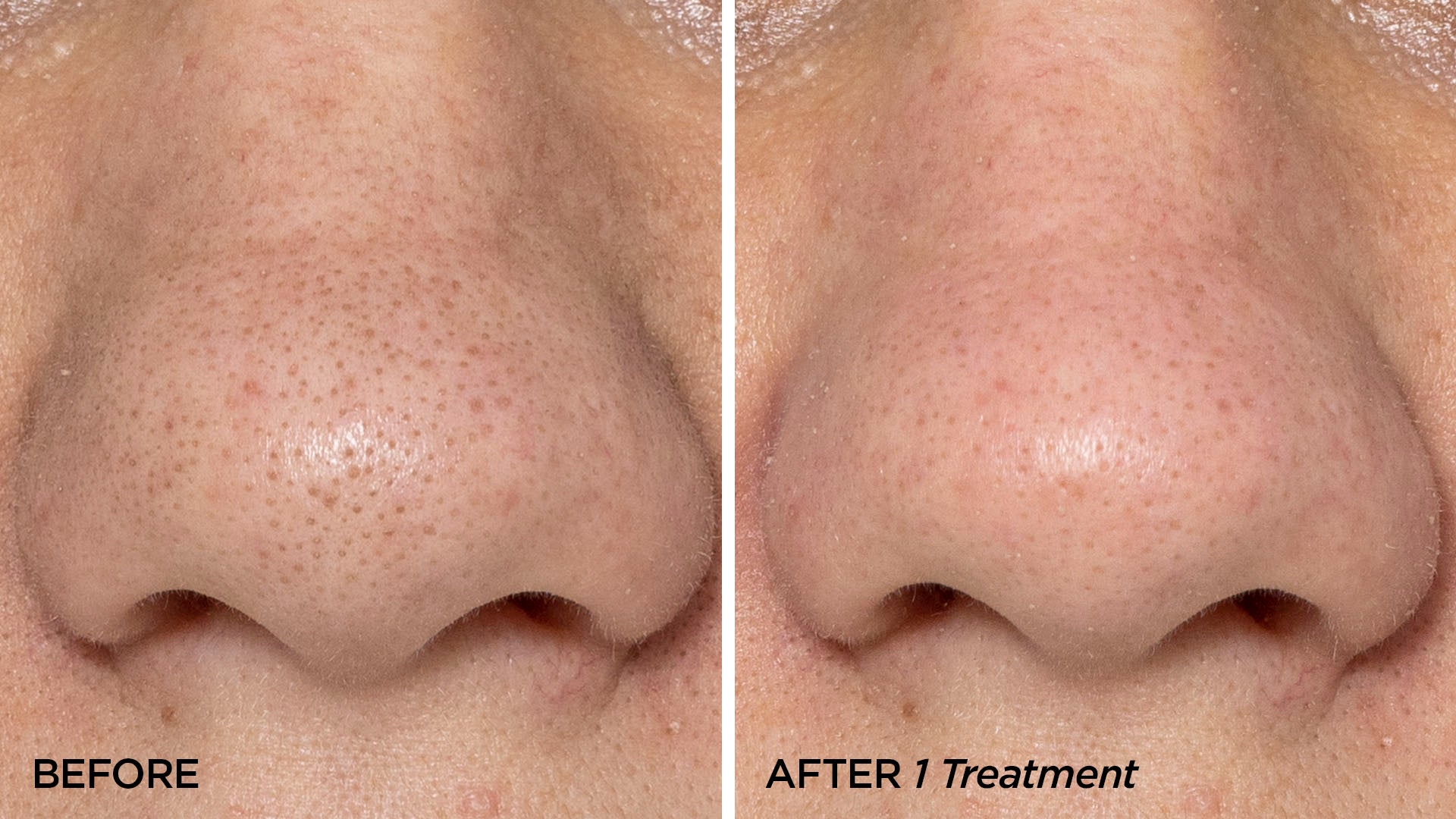 Before & After 1 GLOfacial Treatment