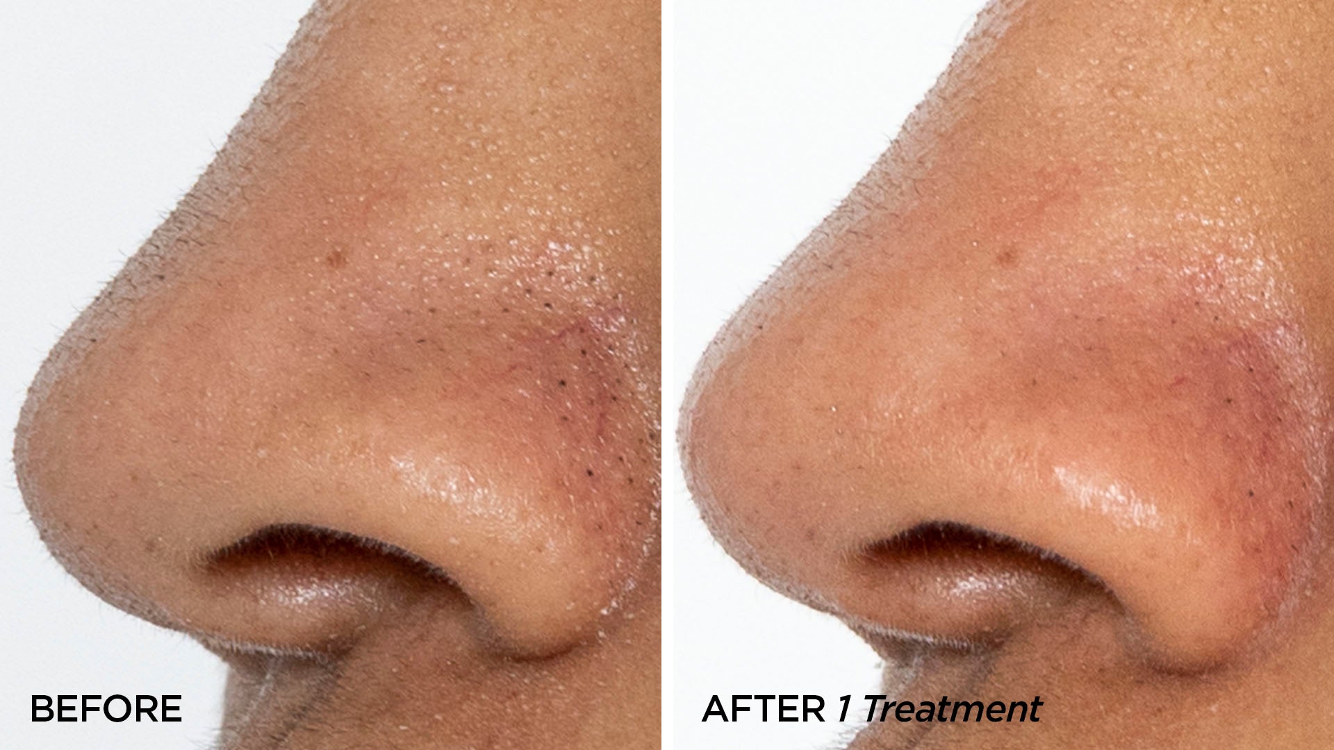 Before & After 1 GLOfacial Treatment