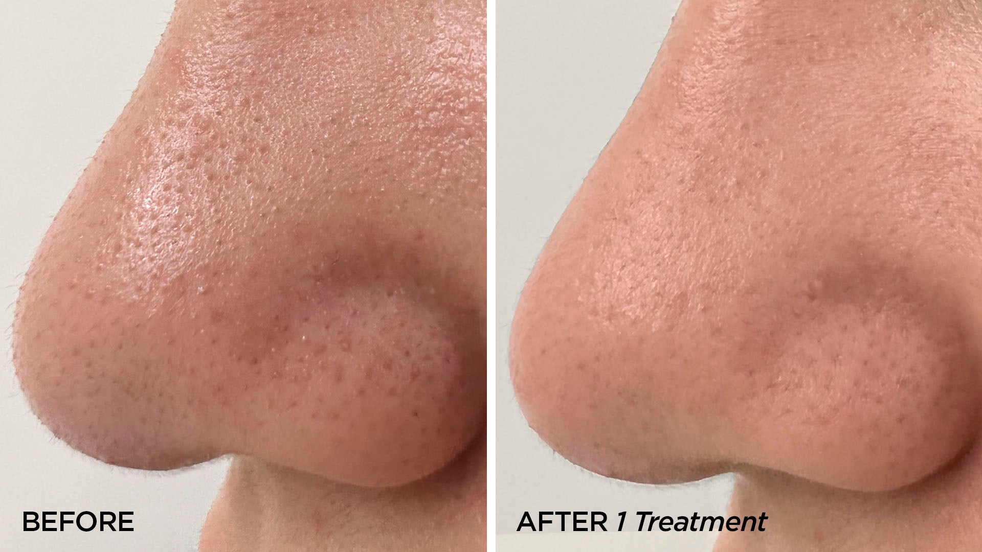 Before & After 1 GLOfacial Treatment