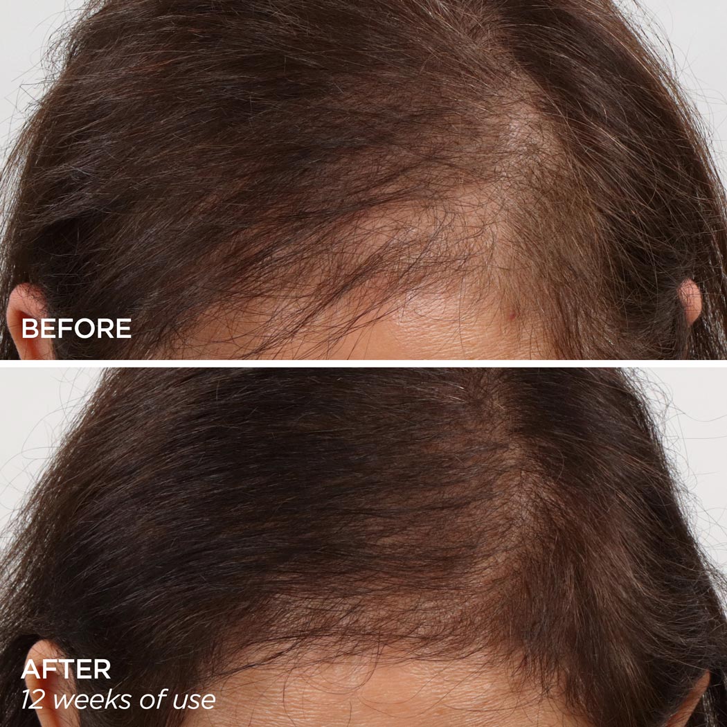 Before & After image using the GloPRO Scalp Attachment