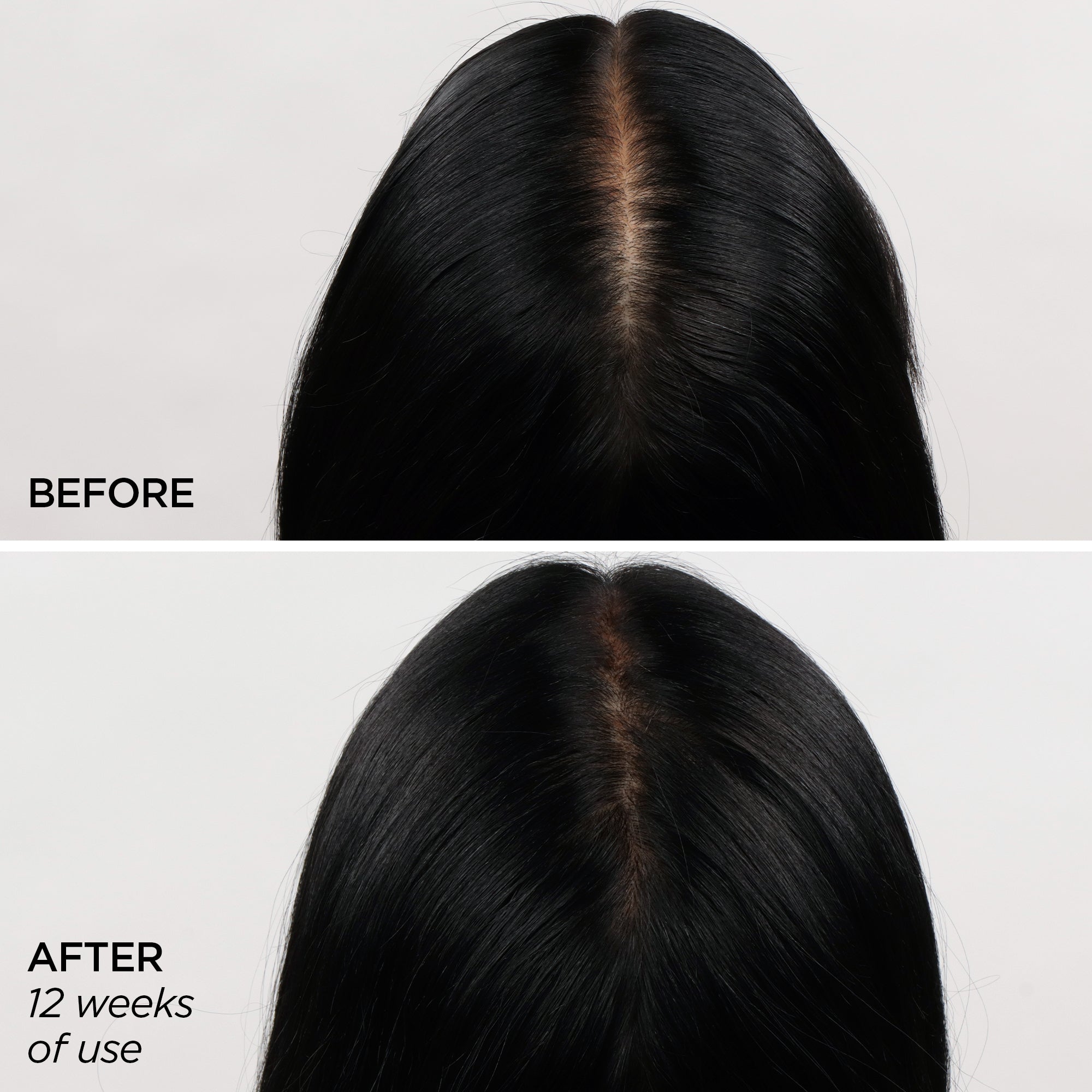 Before & After using the Scalp MicroTip and Scalp Serum