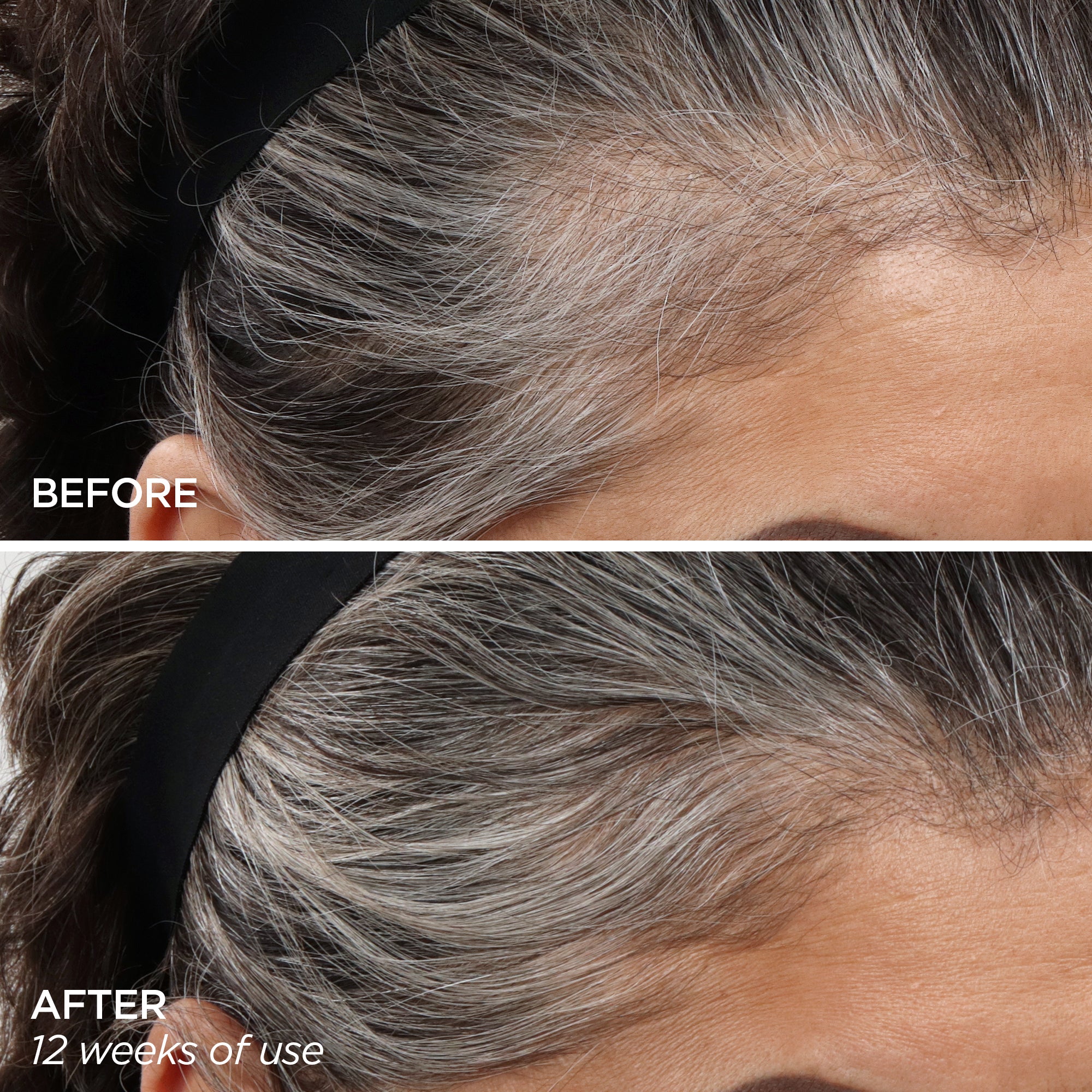 Before & After using the Scalp MicroTip and Scalp Serum