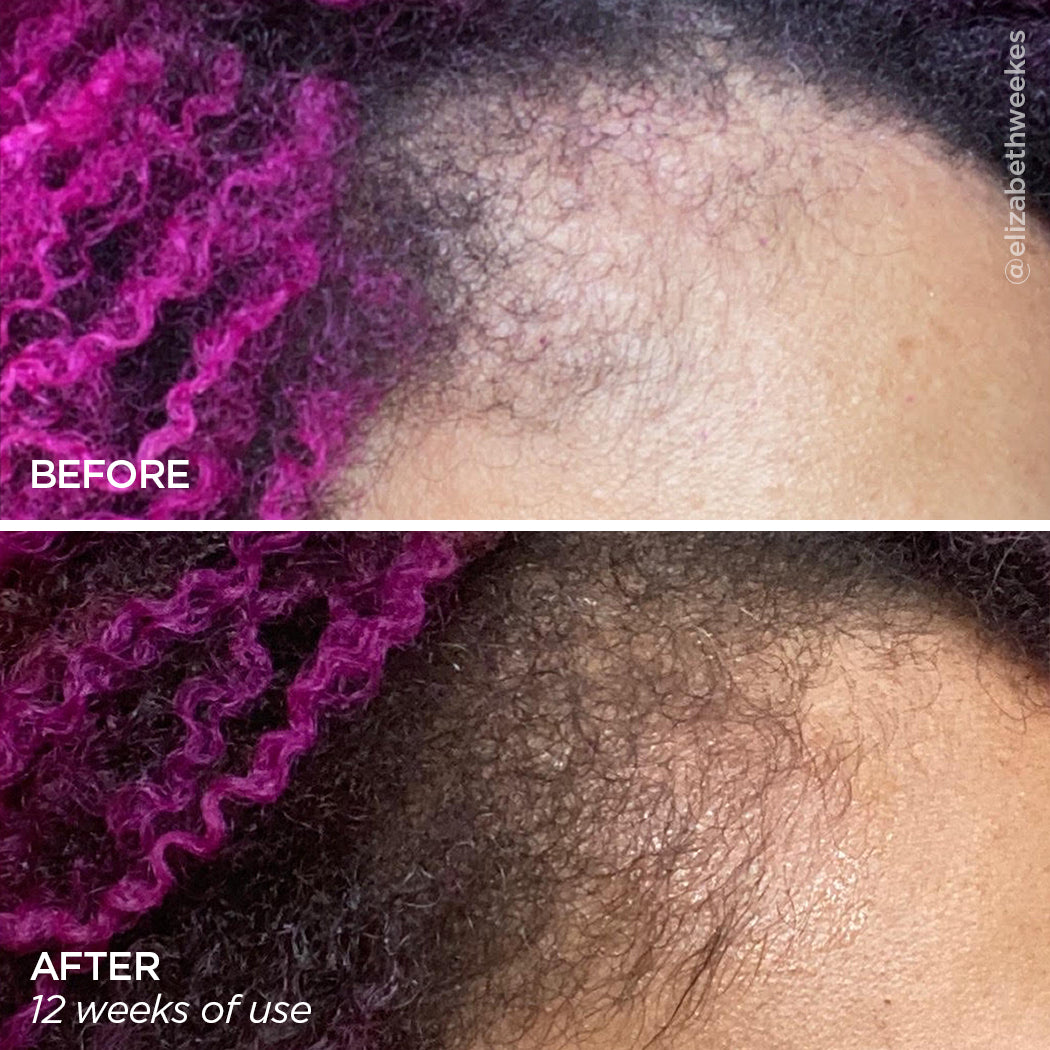 Before & After using the Scalp MicroTip and Scalp Serum