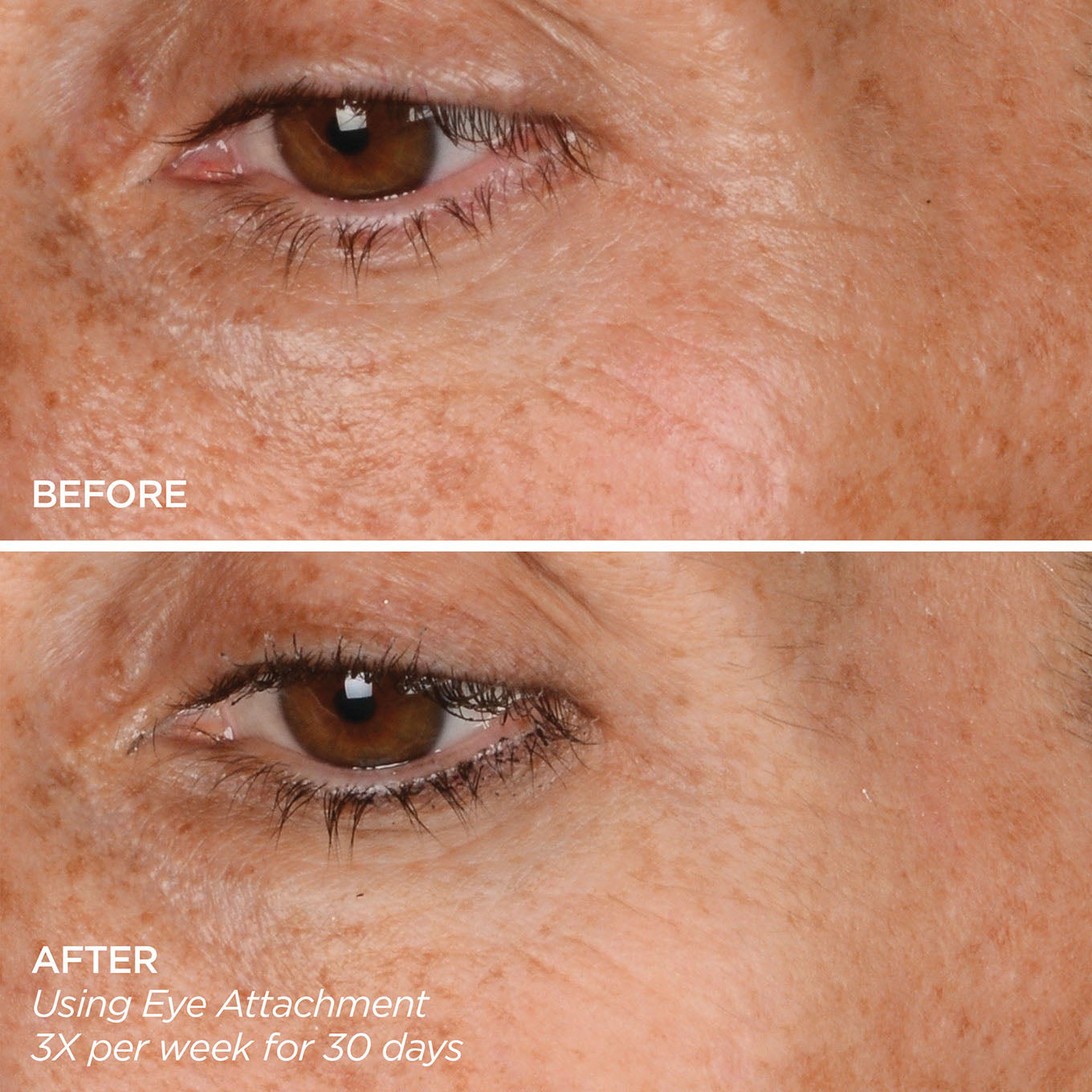 Before & After using Eye Attachment 3X per week for 30 days