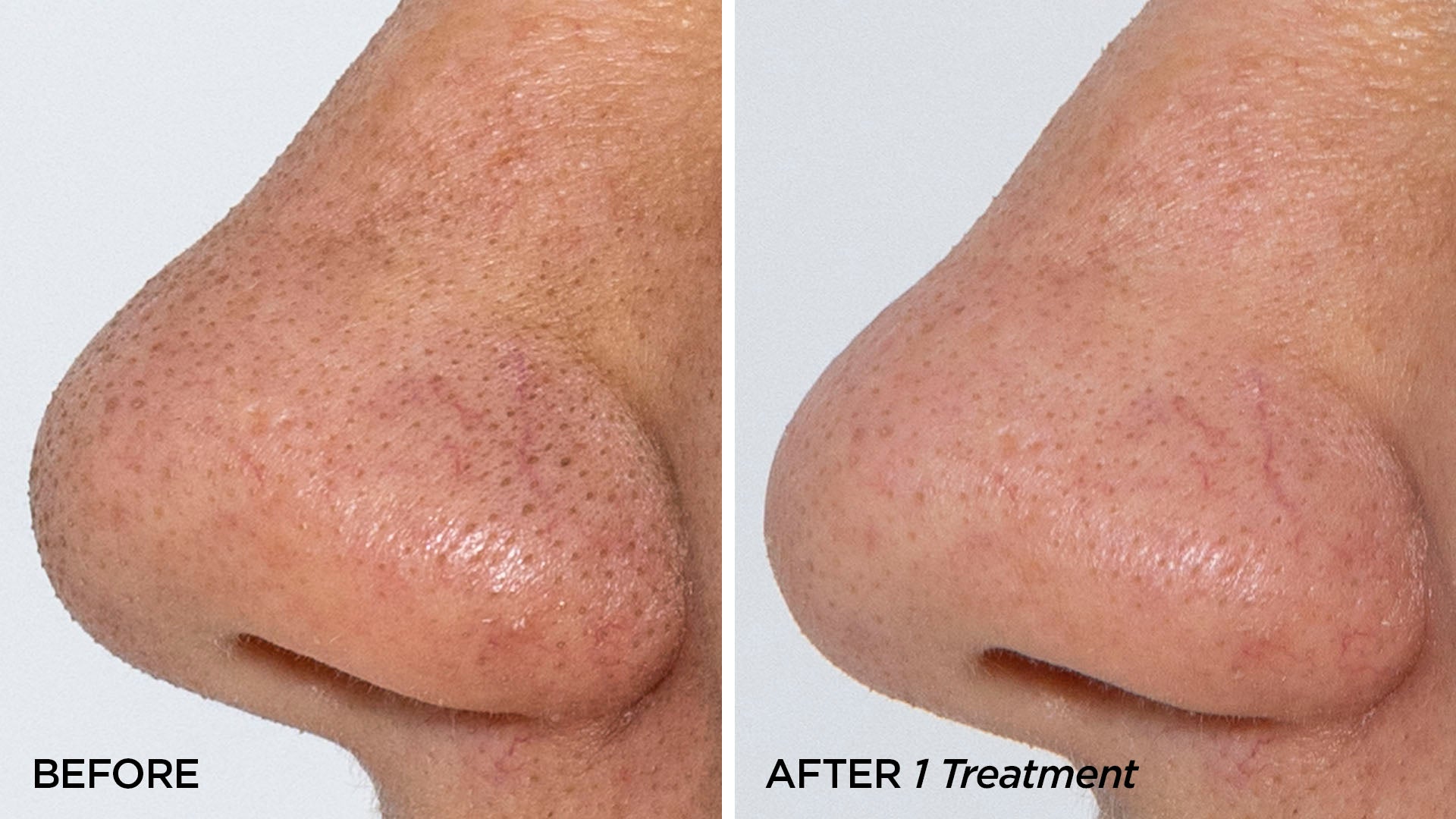 Before & After 1 GLOfacial Treatment