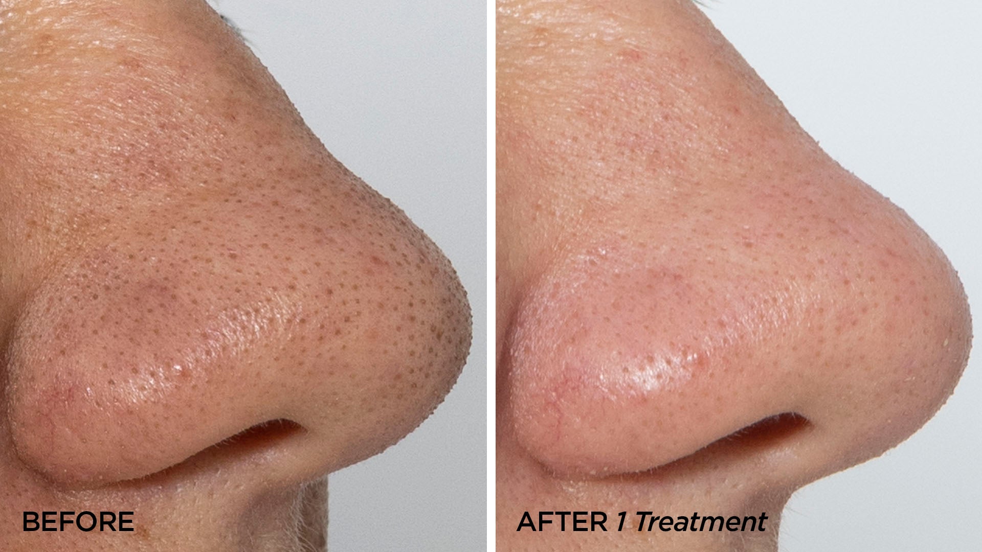 Before & After 1 GLOfacial Treatment