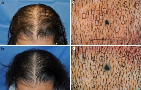 How to Stop Hair Loss in Women TE Hair Loss Tips  Prose Hair