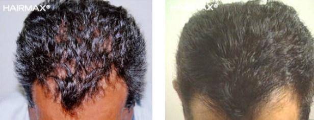 Before and After Plus Clinical Results Photos of Hair Growth – HairMax