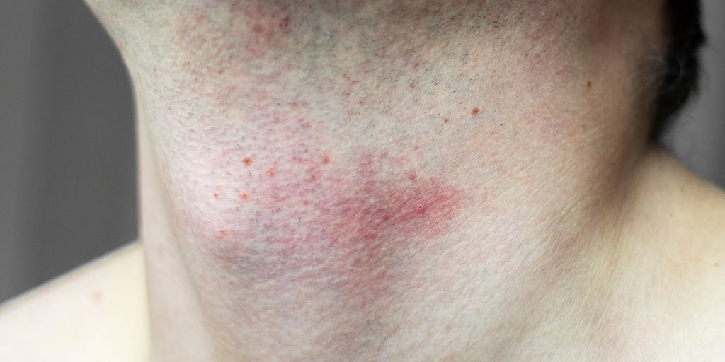 Man with Razor Bumps After Shaving