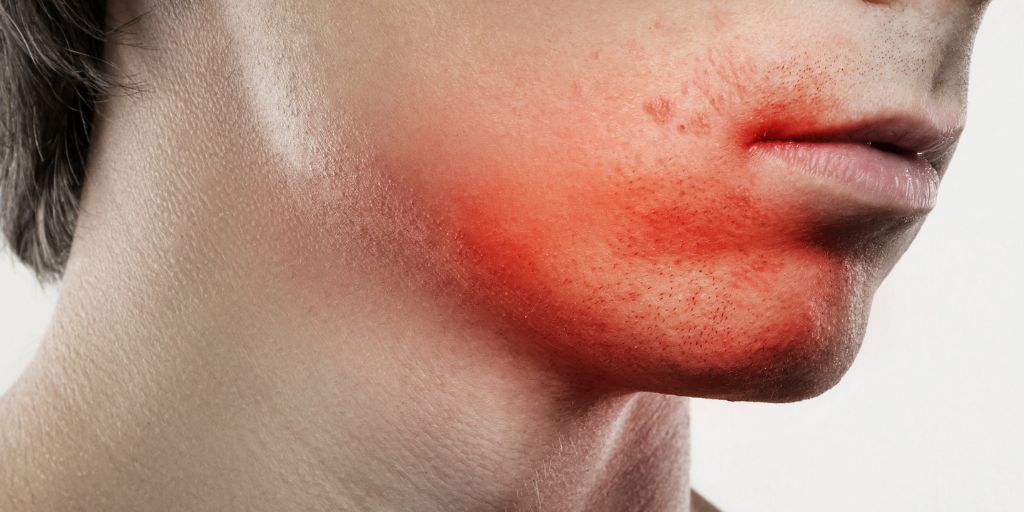 Razor Burn Is Just The Worst- Here's How To Prevent It