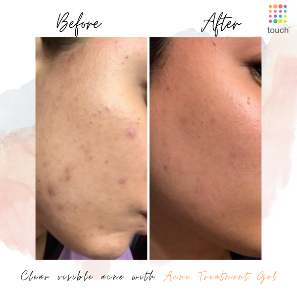 Before and after Acne treatment Gel - Touch Skin Care