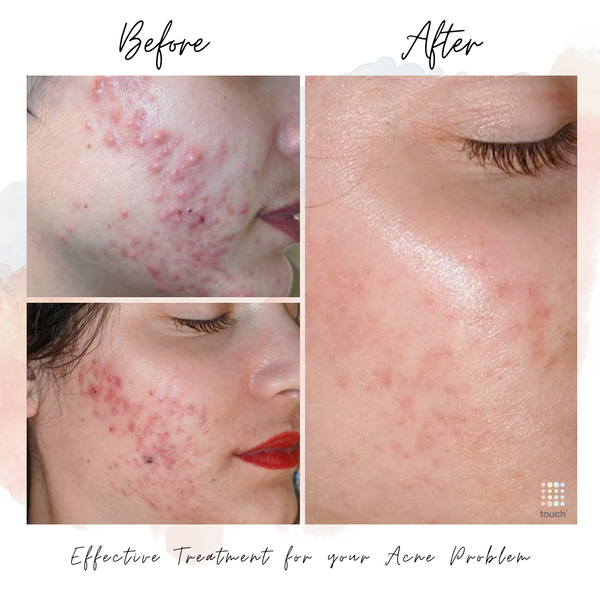 Before and After Acne treatment Gel - Touch Skin Care
