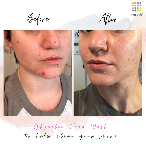 Before and after Glycolic acid cleanser - Touch Skin Care